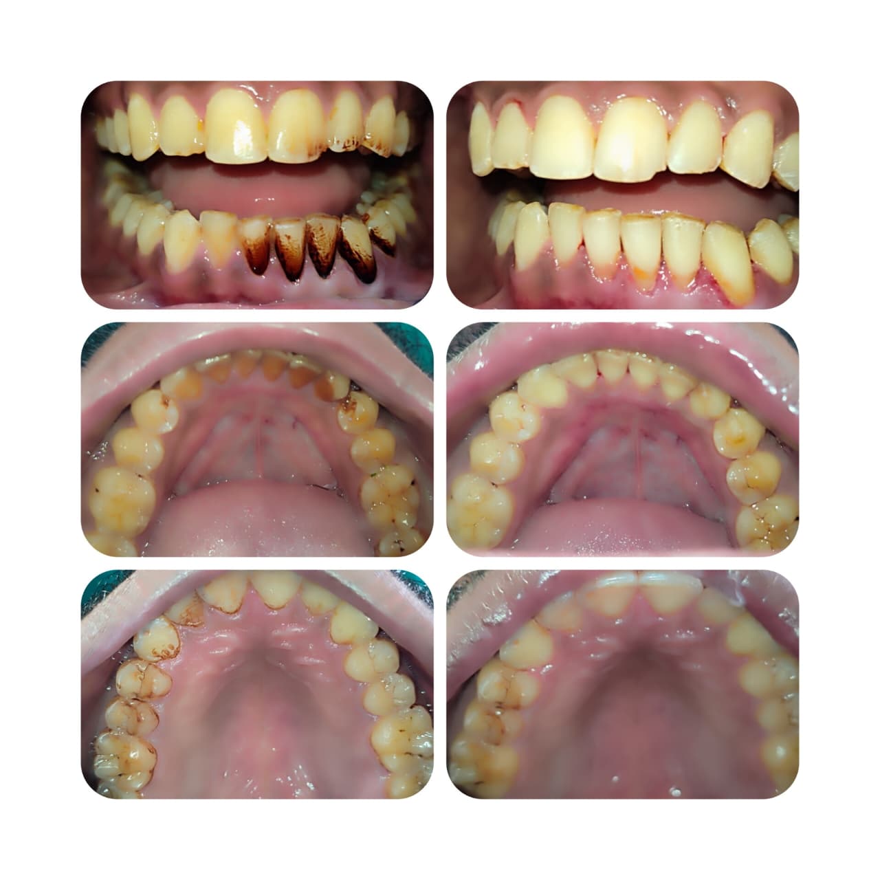 Root Care before-and-after treatment photographs, case 13