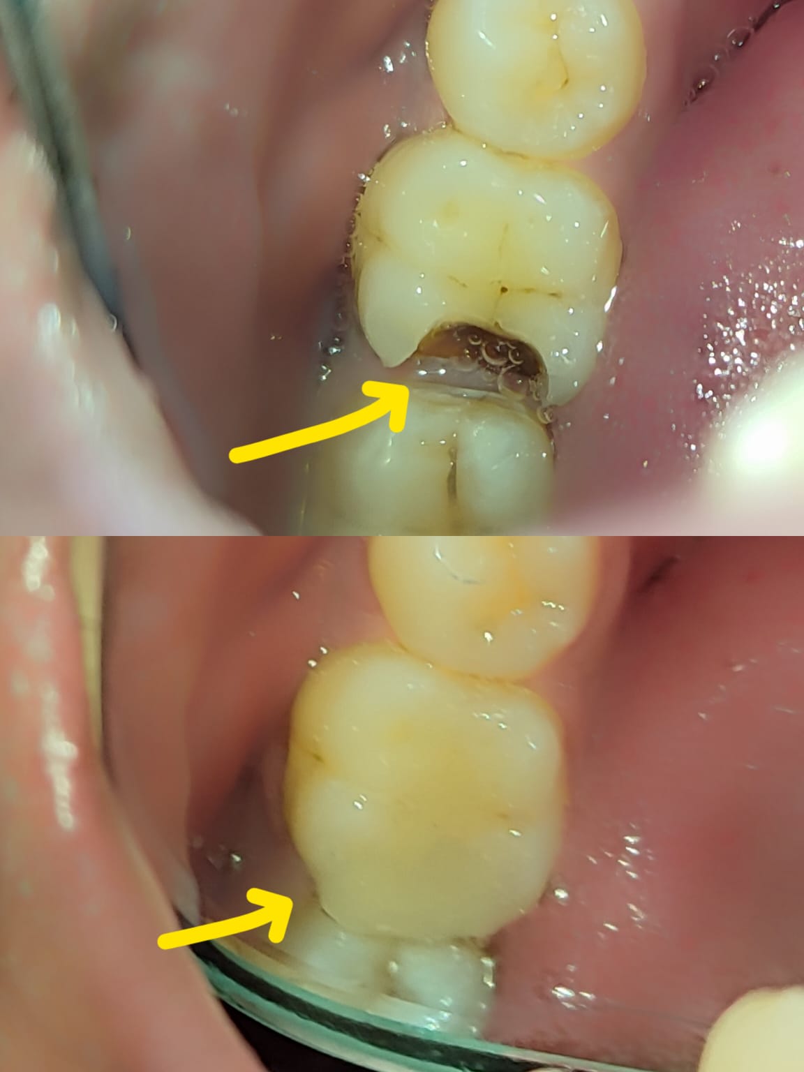 Root Care before-and-after treatment photographs, case 14