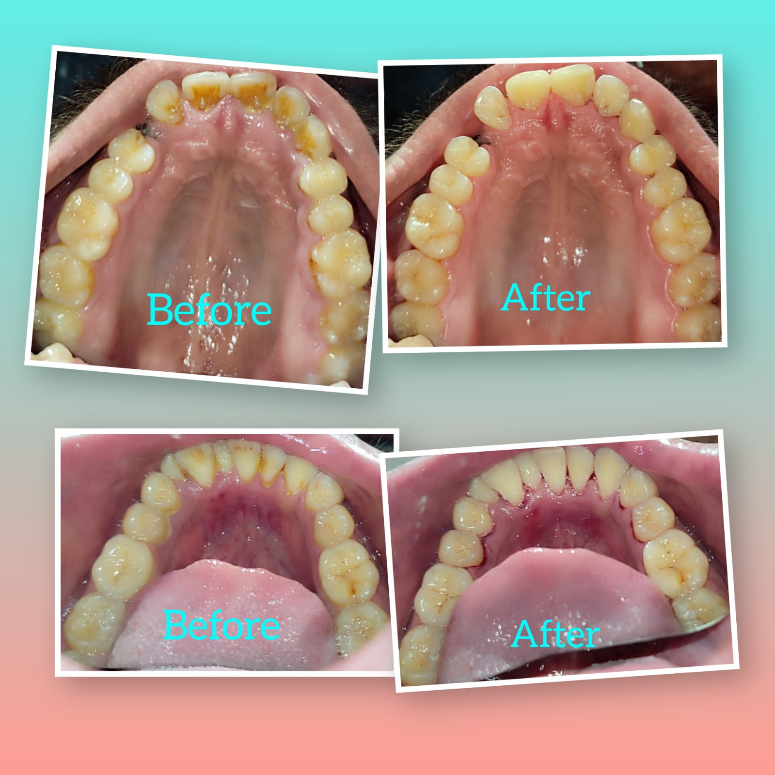 Root Care before-and-after treatment photographs, case 15