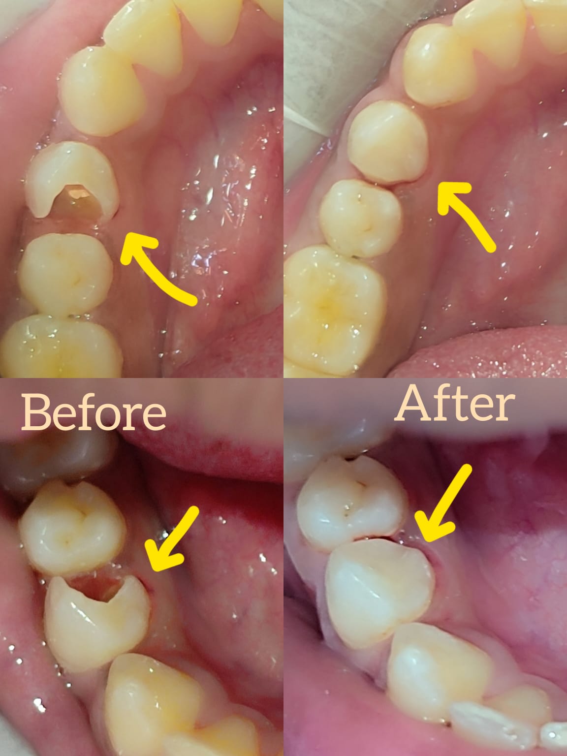 Root Care before-and-after treatment photographs, case 17
