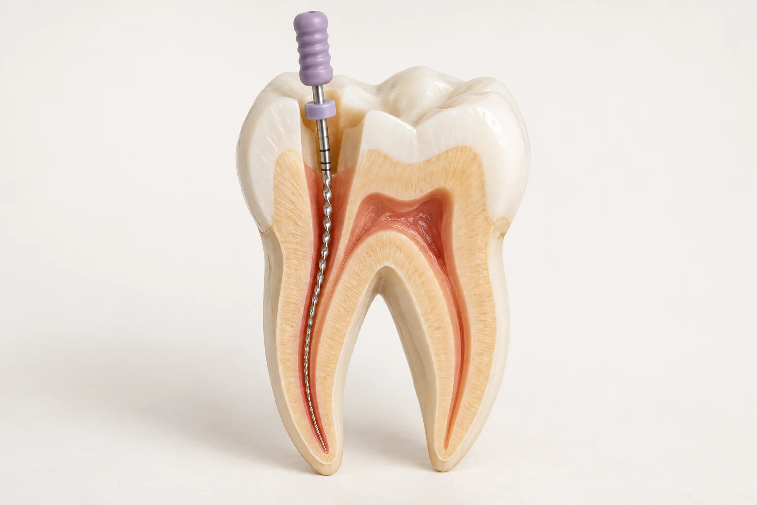 Illustrative cutaway molar model showing a root canal file